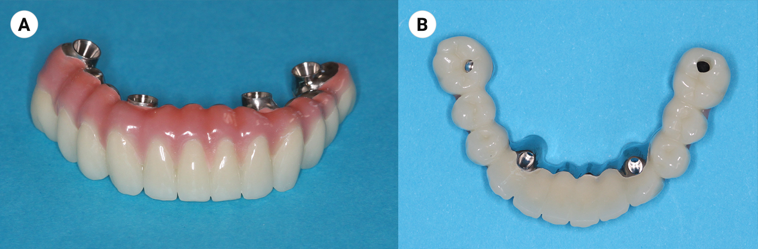 Foto frontale della protesi provvisoria inferiore