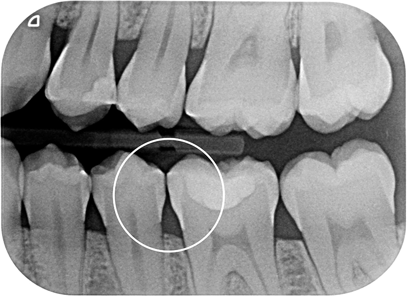 Radiografia dopo 6 mesi dall'applicazione