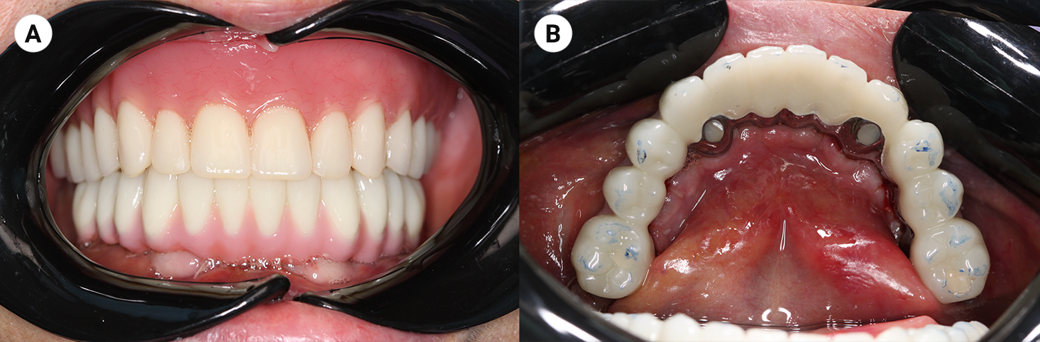 Foto frontale intraorale della protesi provvisoria in rapporto occlusale