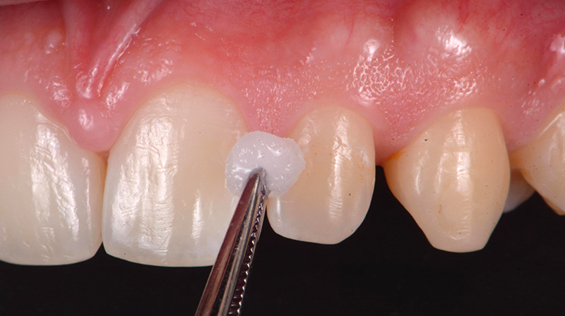 Rimozione della pellicola organica con Ipoclorito di sodio al 2%