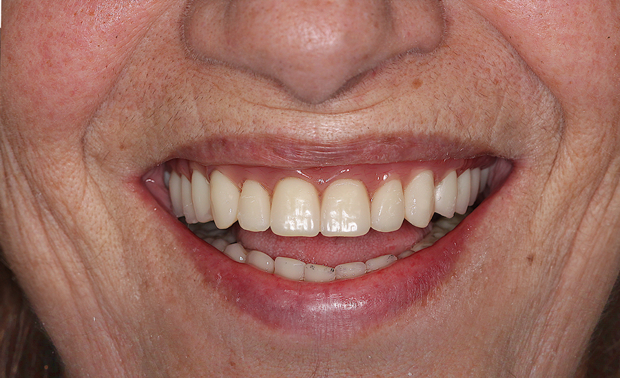 Foto frontale extra-orale macro del sorriso a fine riabilitazione con protocollo ScanSke