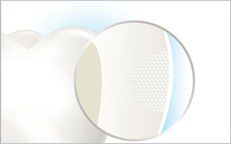 progressione della lesione cariosa arrestata