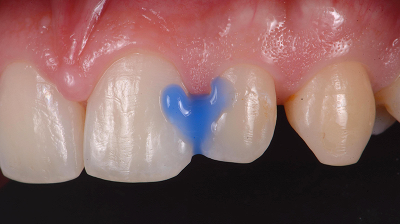 Mordenzatura con Acido Ortofosforico