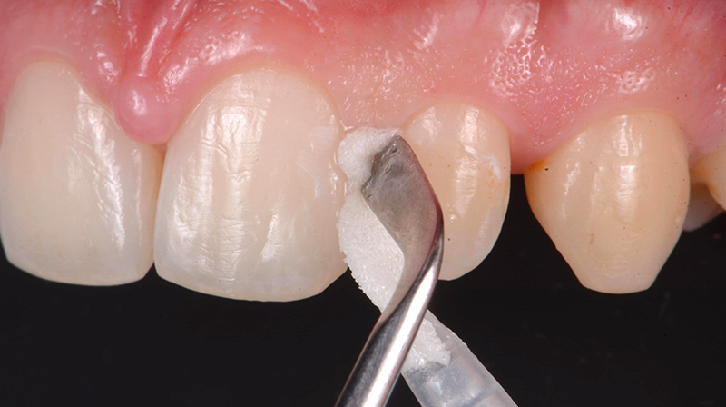 Applicazione Curodont Repair