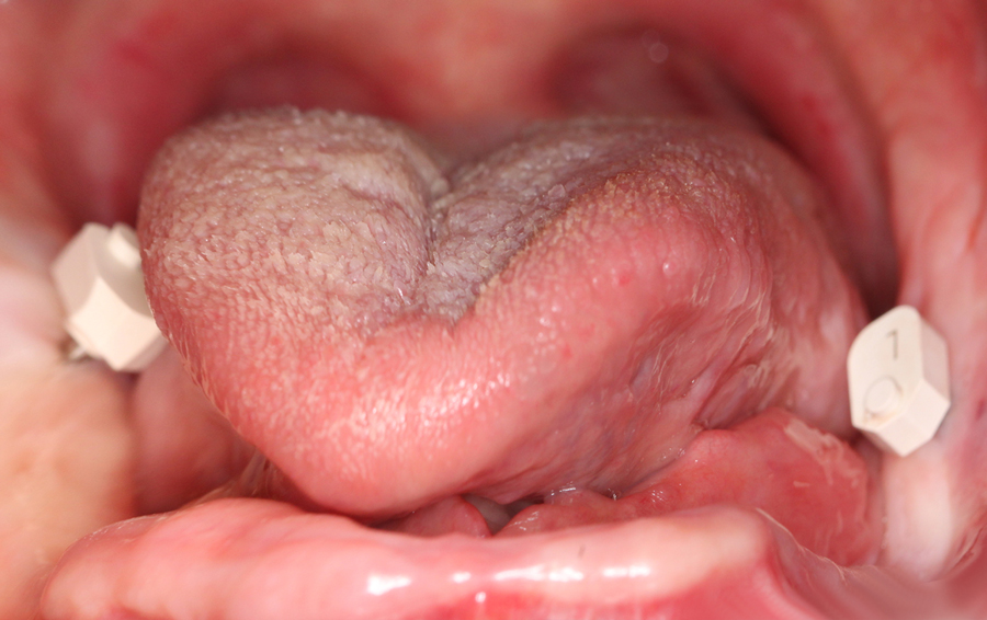 Foto intraorale pre-chirurgica