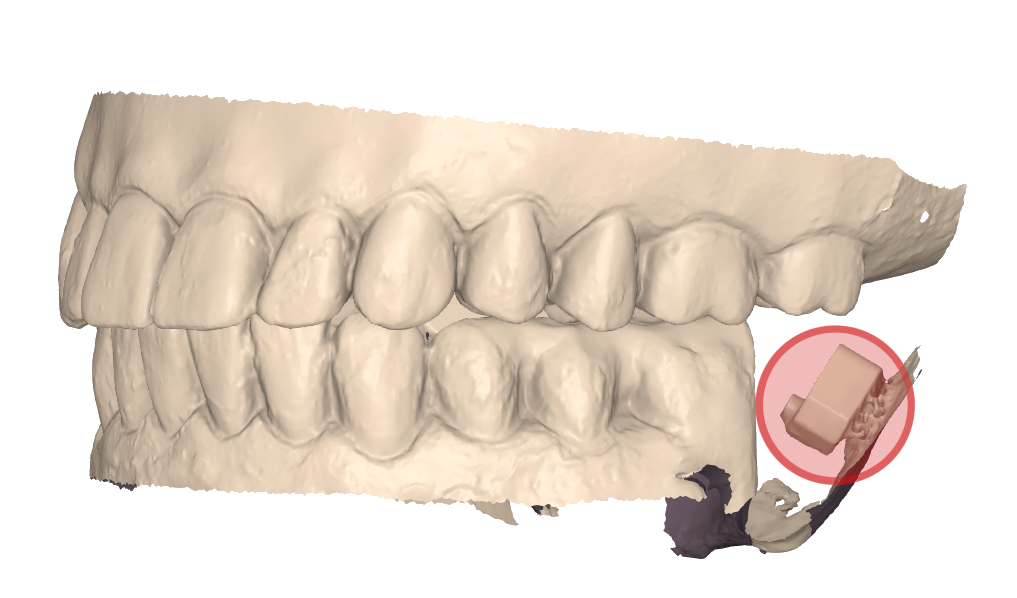 rendering 3D della scansione rilevata in massima intercuspidazione