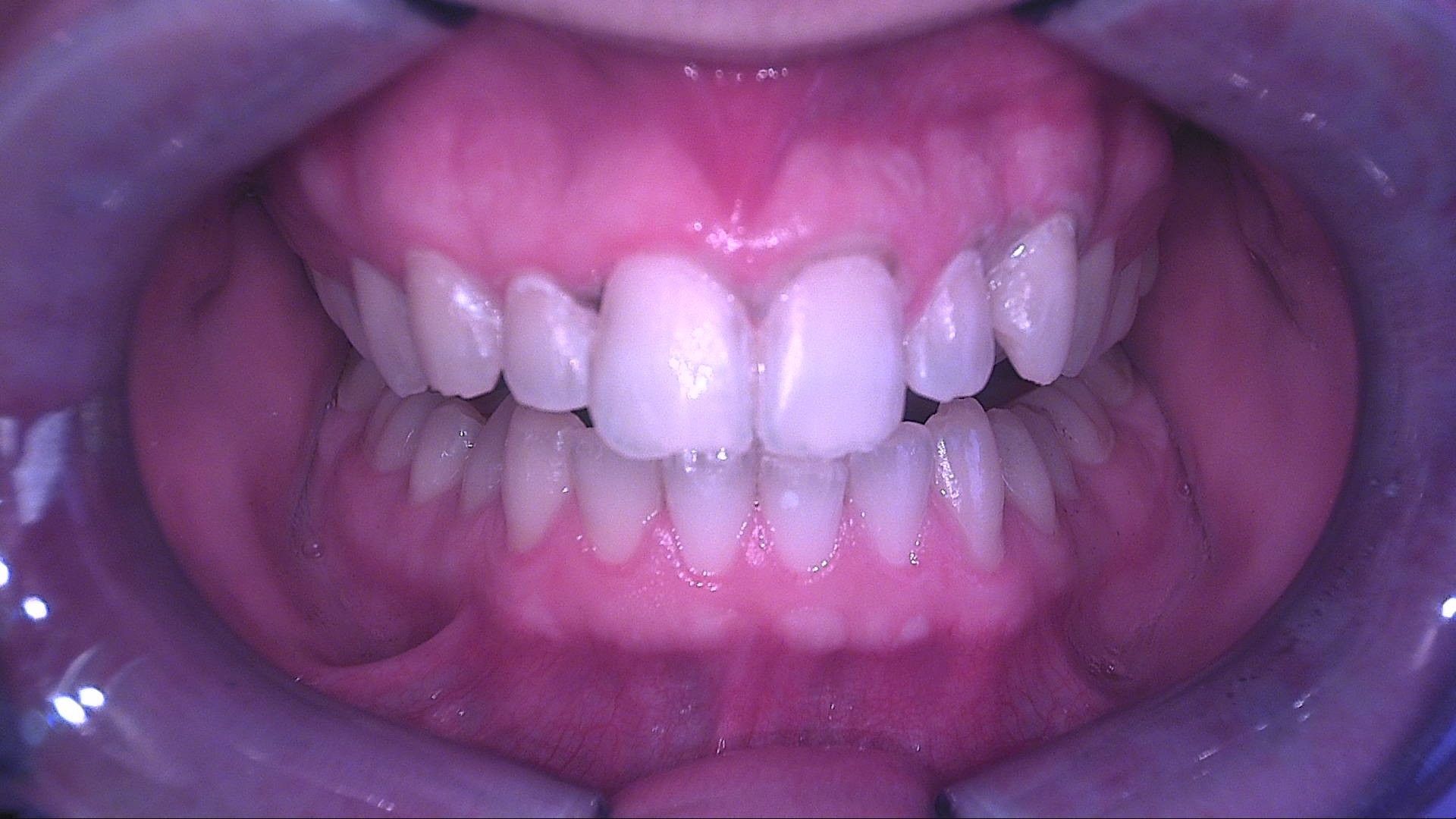 Luce bianca subito dopo l'infiltrazione