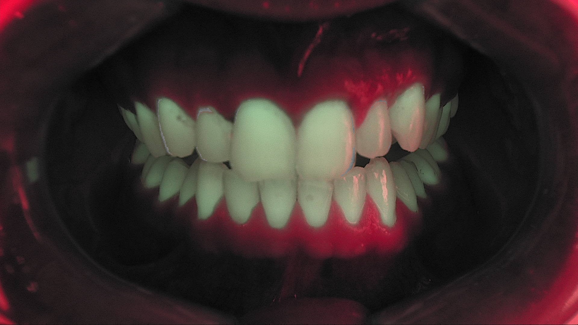 Fluorescenza immediata post-trattamento