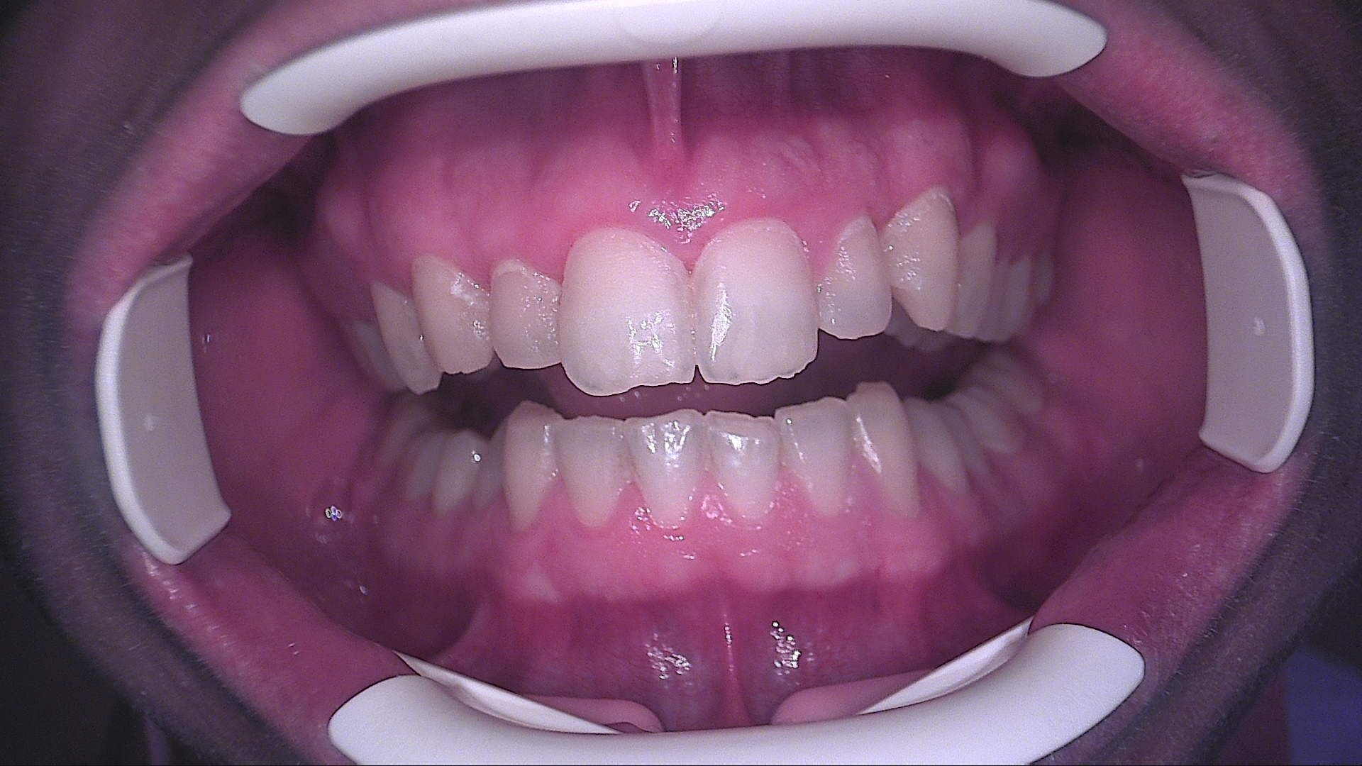 Controllo a un mese in luce bianca