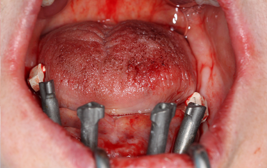 Foto successiva all’inserimento degli impianti