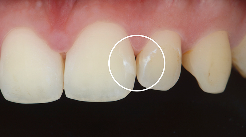 White spots post-ortodontiche