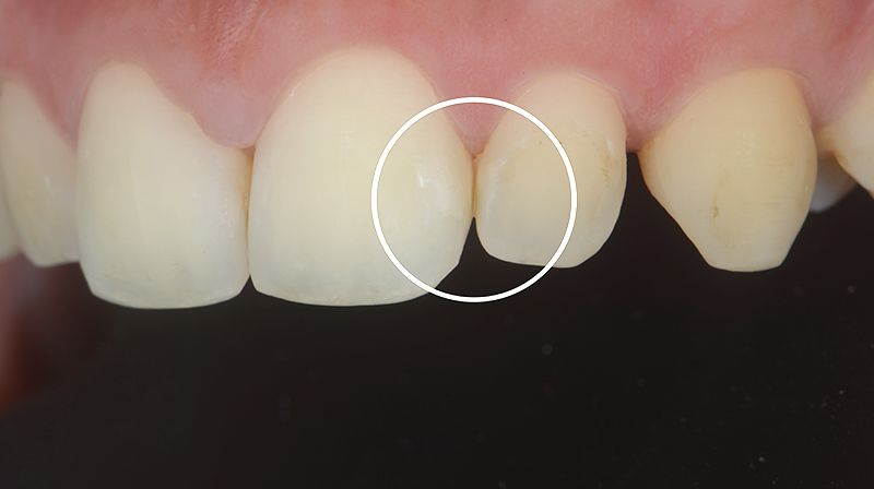 dopo 16 mesi dall'applicazione di CURODONT REPAIR