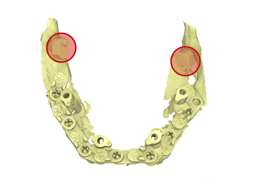 file .stl dell’impronta inferiore
