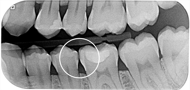 Radiografia prima dell'applicazione