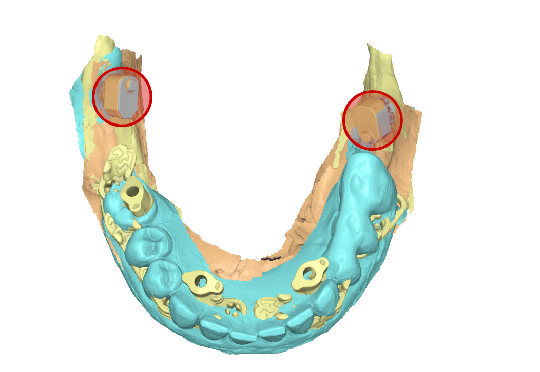 file .stl della sovrapposizione delle tre scansioni