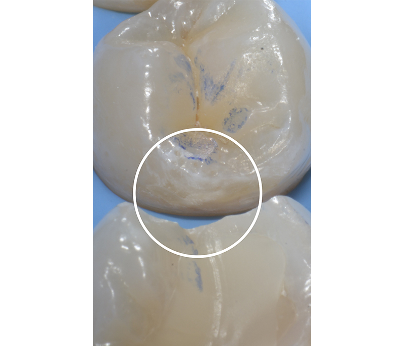 lesione cariosa prima dell'applicazione