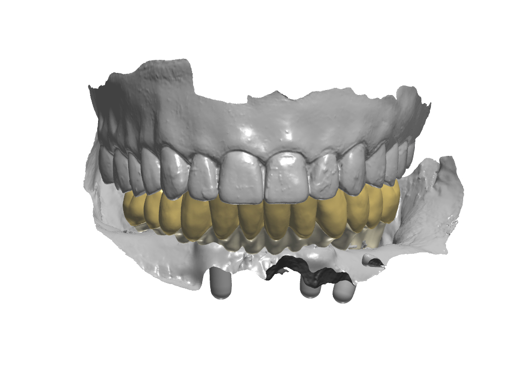 Prospettiva frontale della protesi progettata