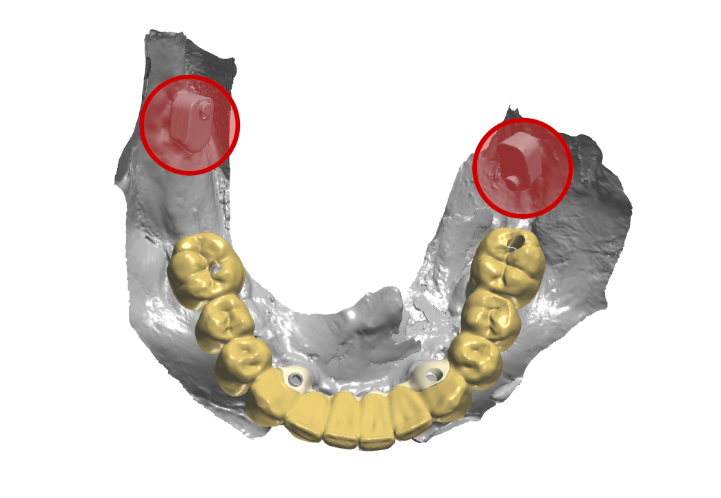 Prospettiva dall’alto della protesi inferiore