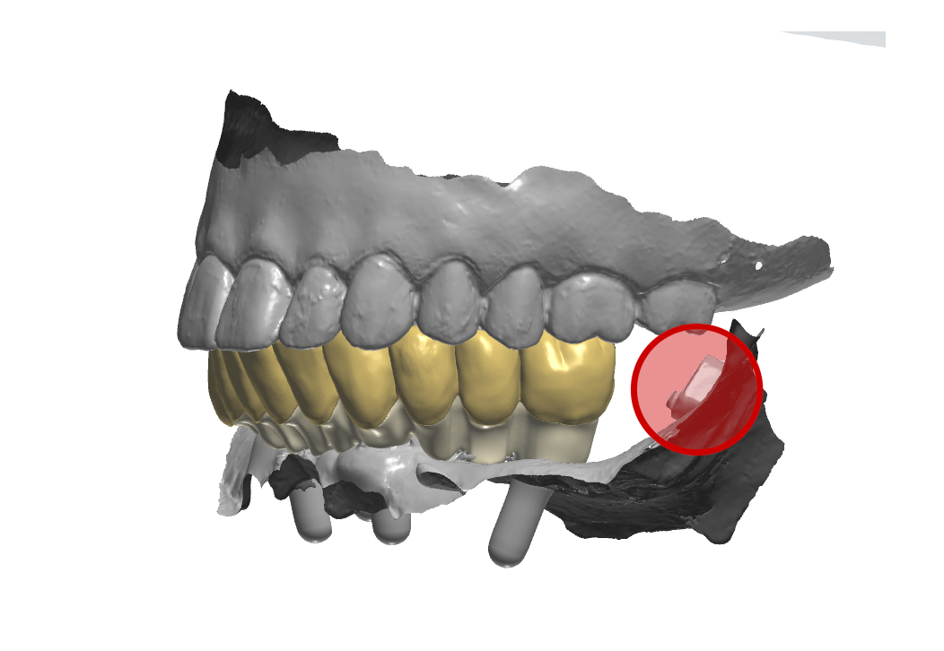 Prospettiva laterale sinistra della protesi in occlusione