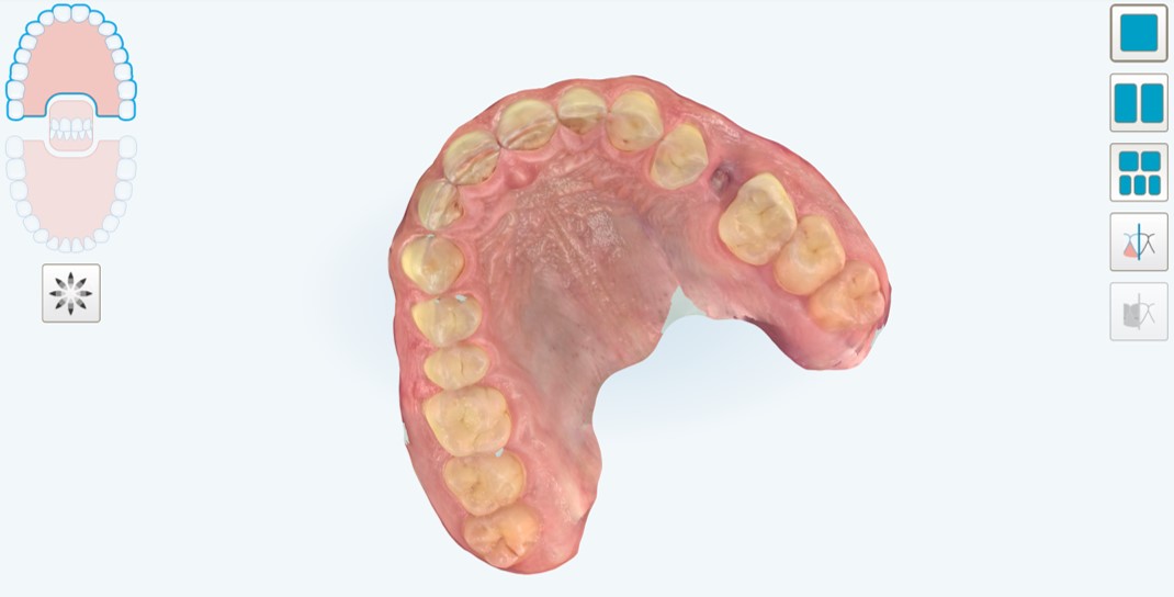 Situazione pre-operatoria, visione occlusale