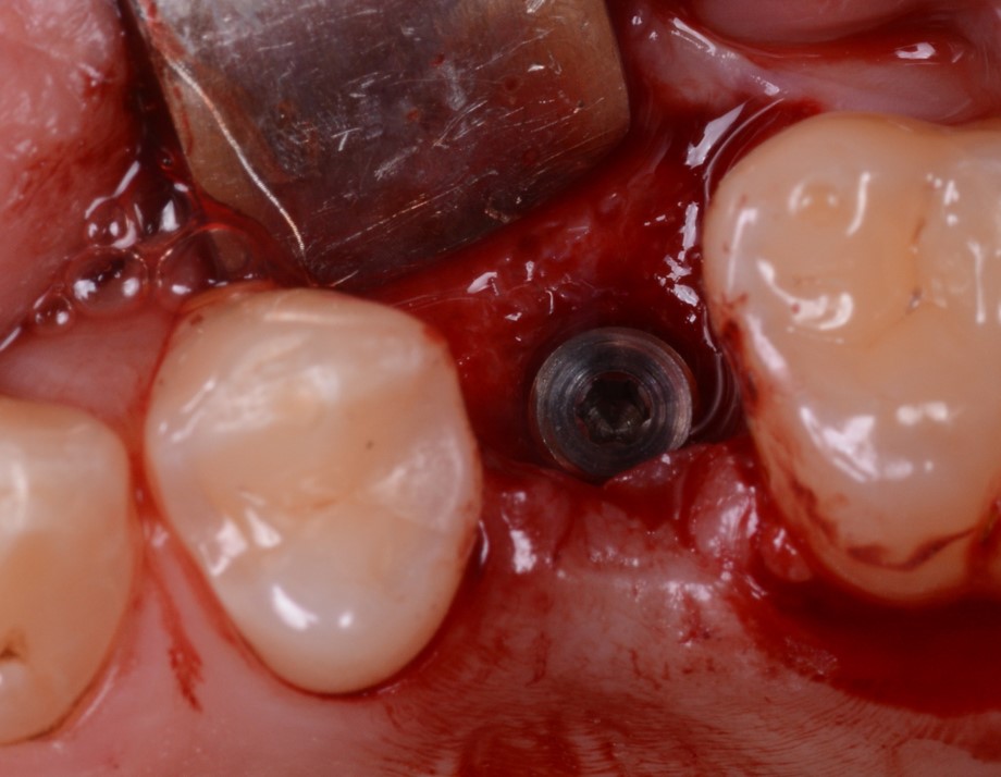 L’impianto inserito nell’alveolo post-estrattivo