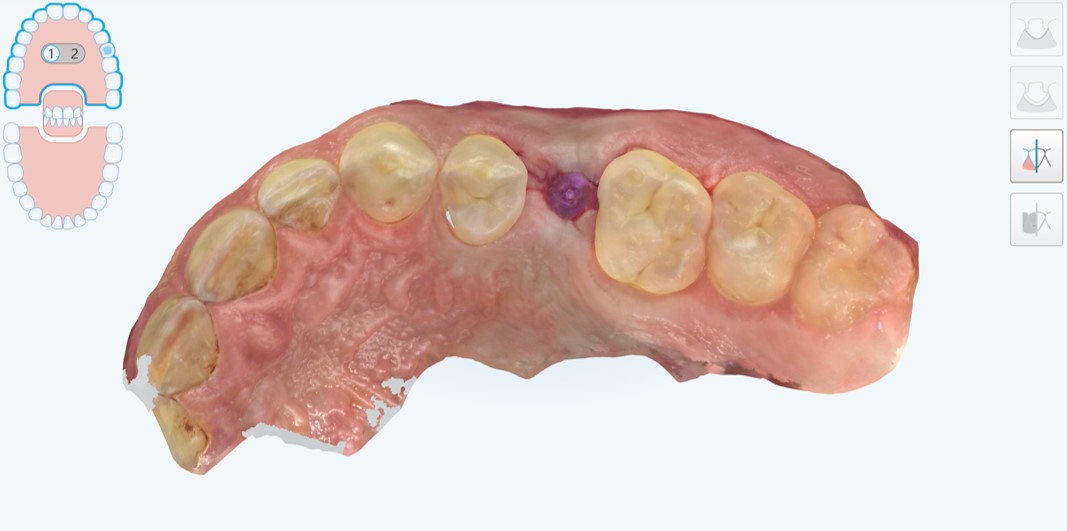 impronta ottica con potente scanner intraorale