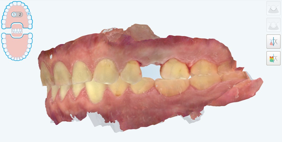 Impronta ottica del modello master con il collare mucoso esposto