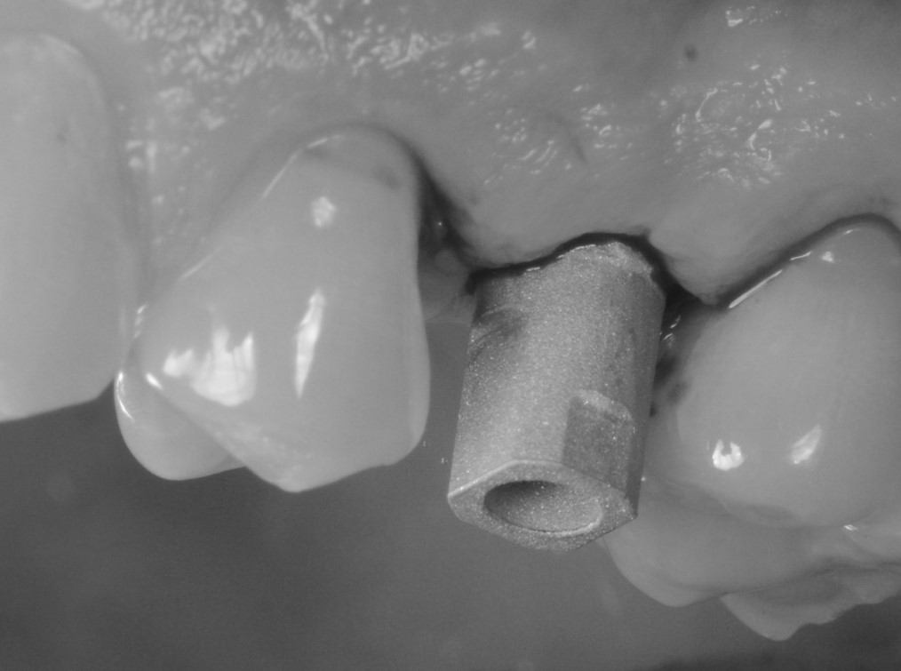 Inserimento dello scanbody one-piece in titanio