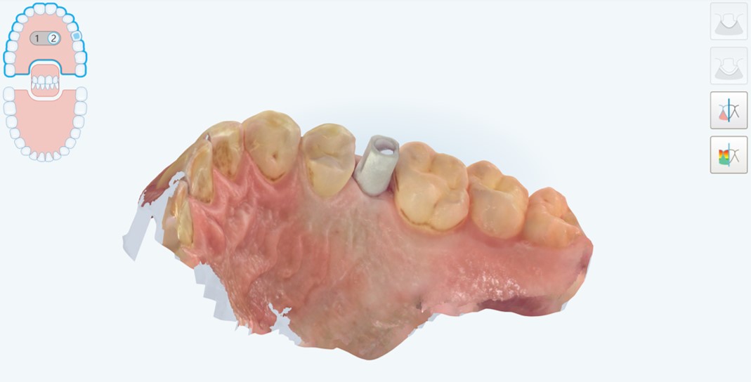 Visione occlusale della scansione del modello master con lo scanbody in posizione