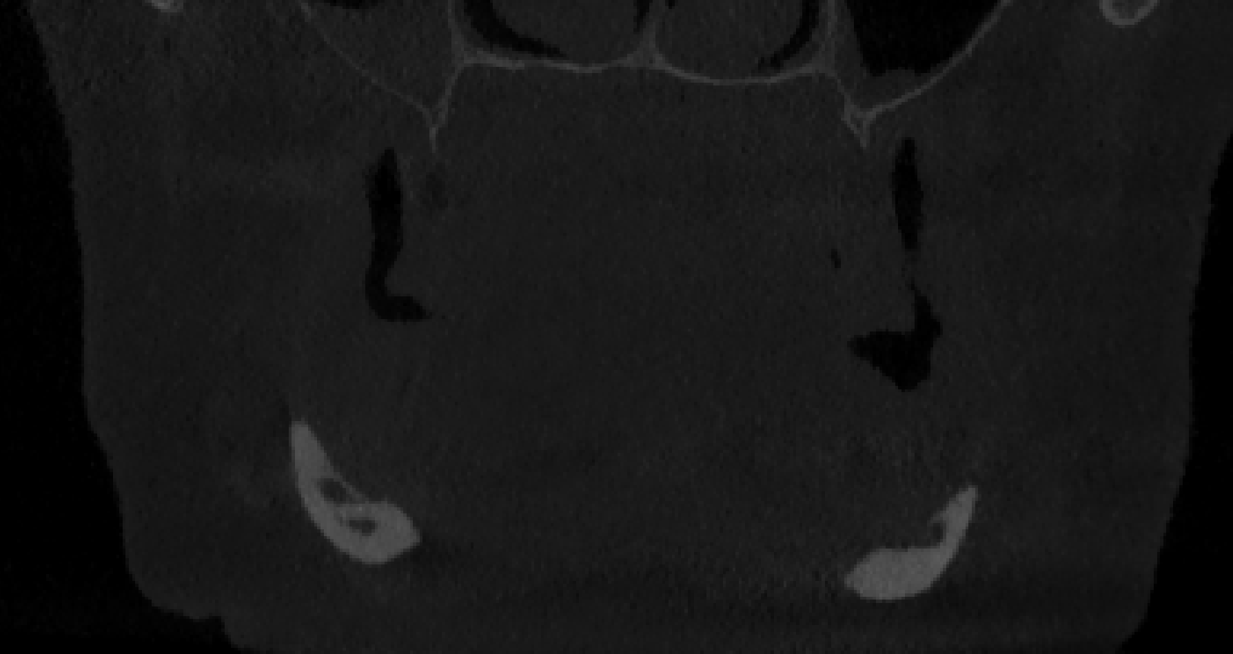 atrofia della mandibola e nervo scoperto