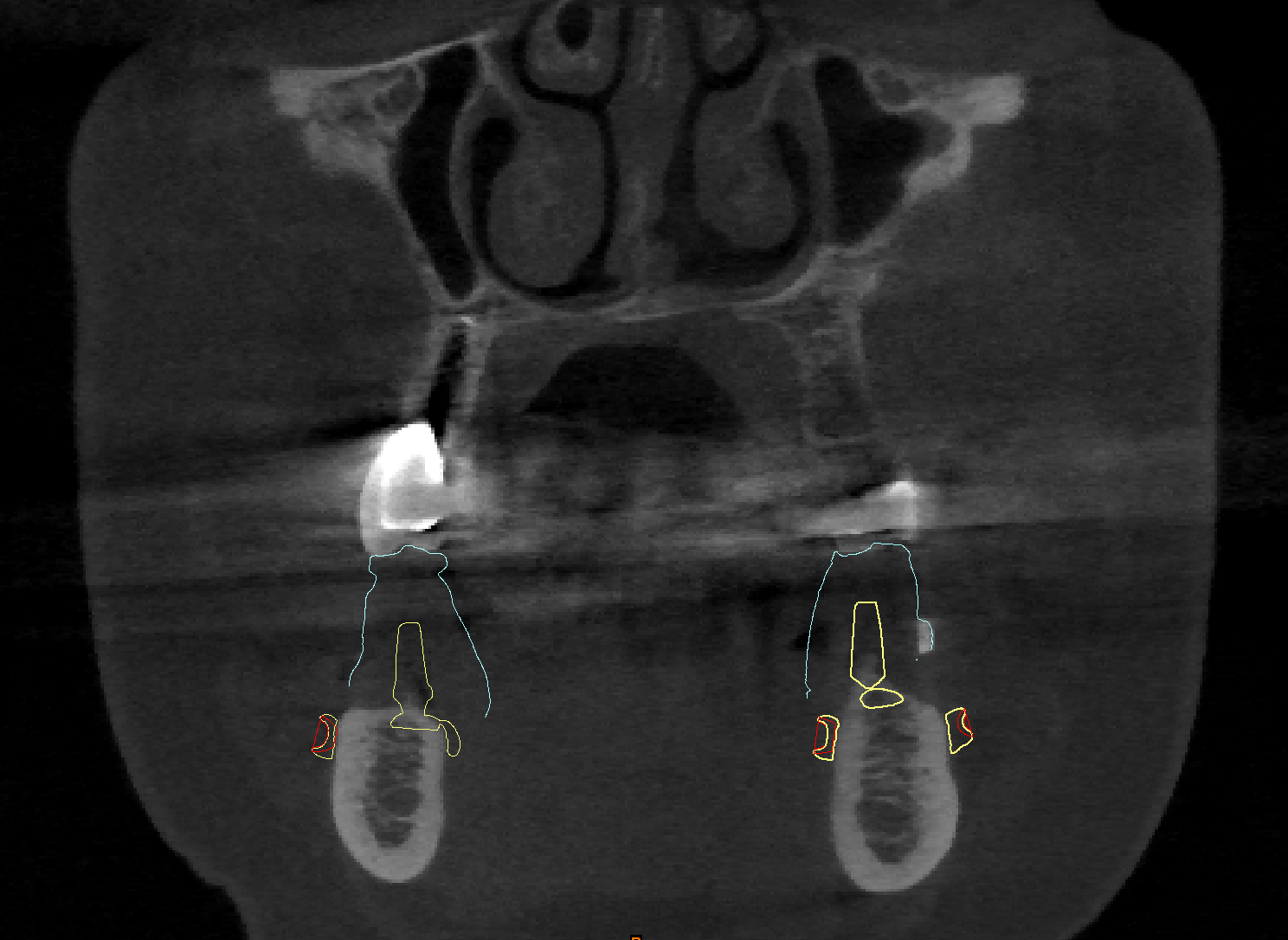 Vista coronale degli impianti in sezione.