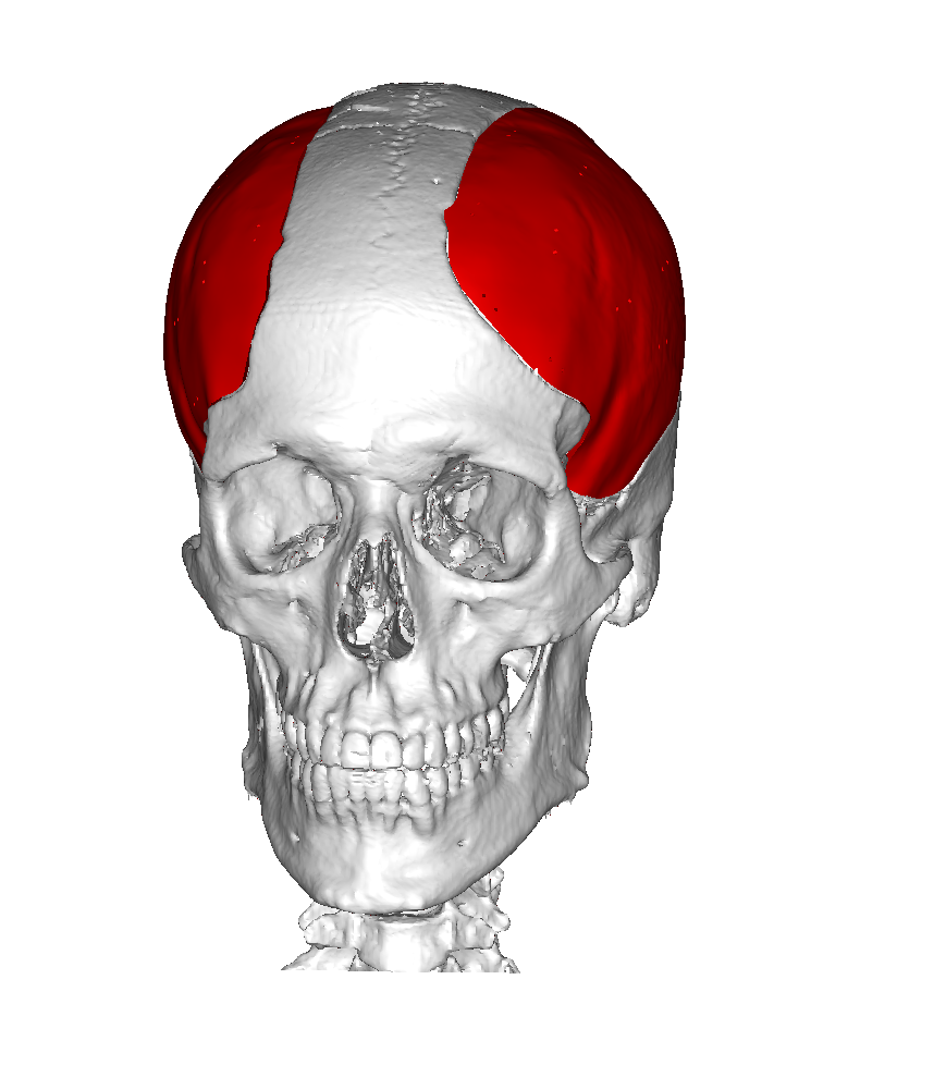 Design di una cranioplastica