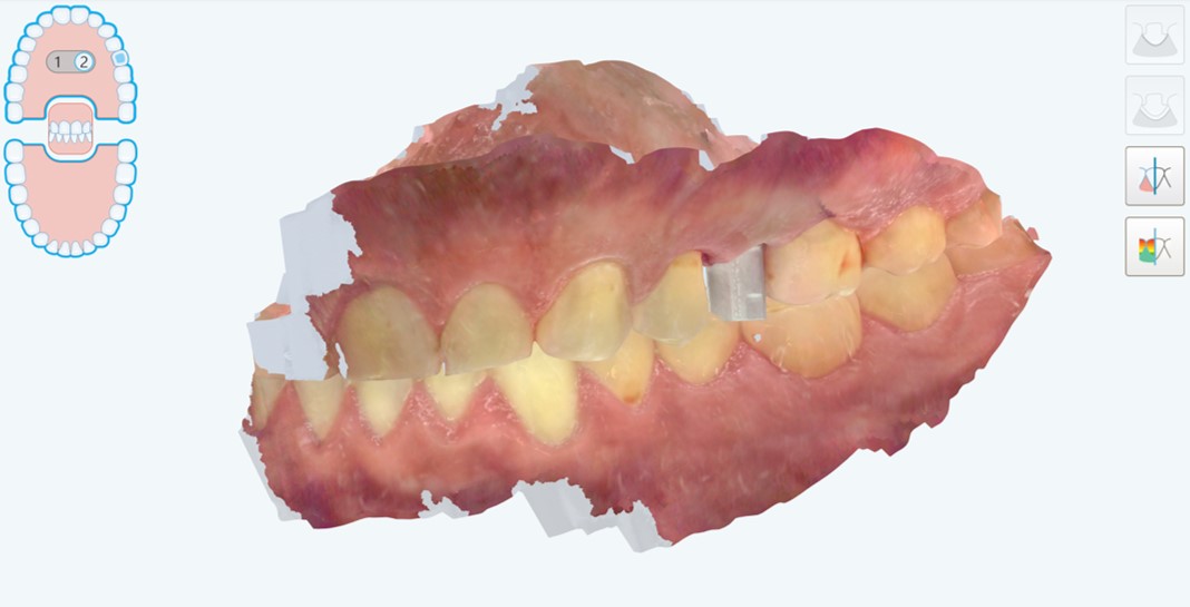 Visione laterale dello scanbody