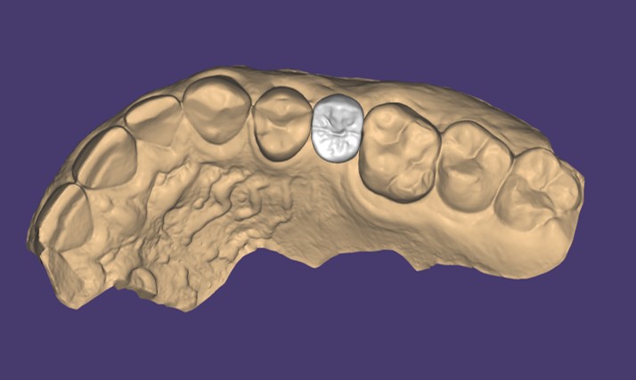 Modellazione CAD di corona definitiva, visione occlusale