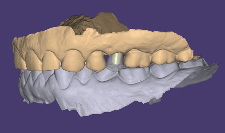 Modellazione CAD di corona definitiva in trasparenza con il moncone