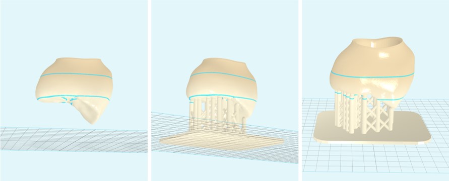 Preparazione della corona definitiva alla stampa con stampante stereolitografica
