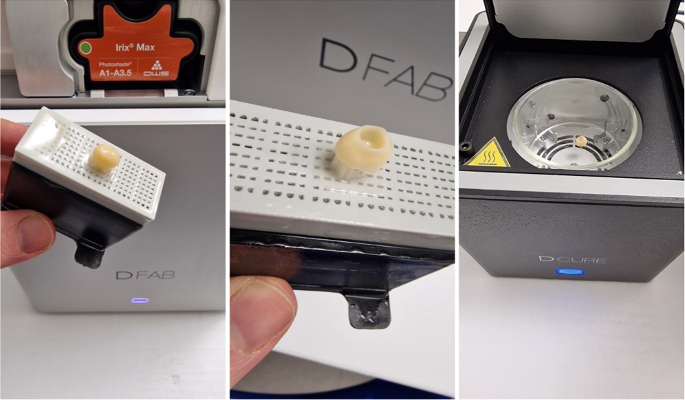 La corona definitiva appena stampata in materiale composito ibrido caricato con ceramica