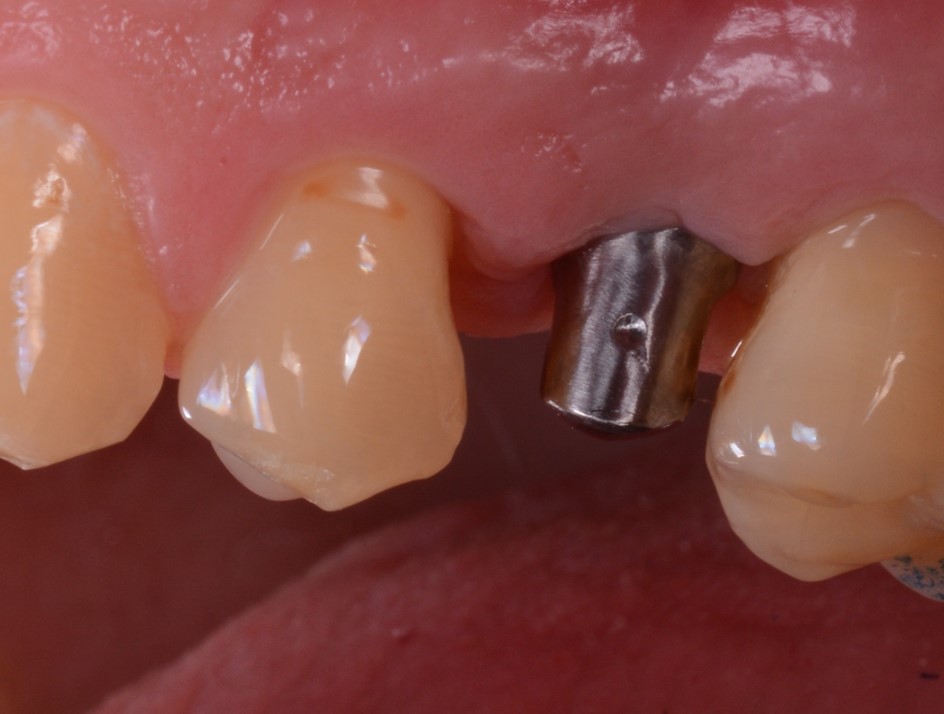 Inserimento del moncone individuale in titanio