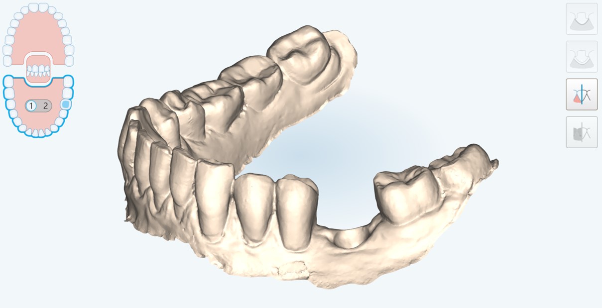scansione intraorale