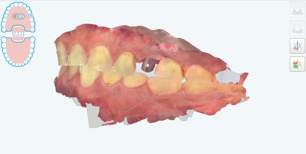 Scansione intraorale del moncone in posizione