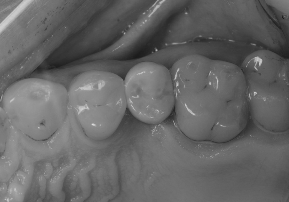 Consegna del restauro, visione occlusale