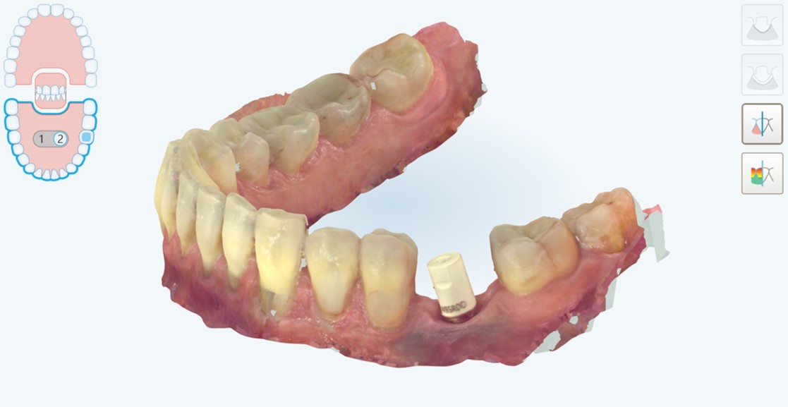 scanbody in posizione