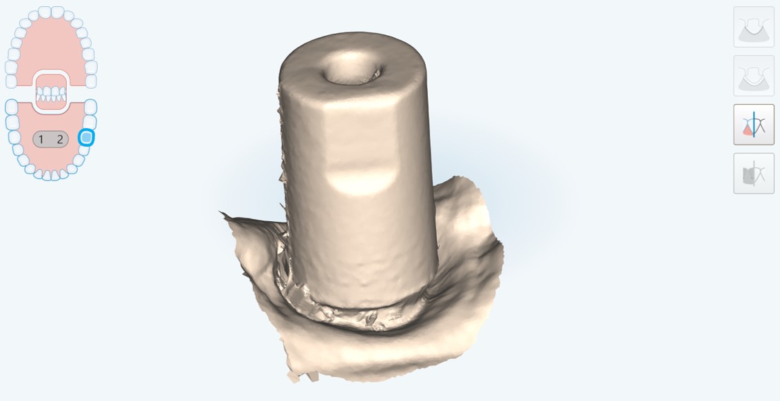 scanbody alta definizione