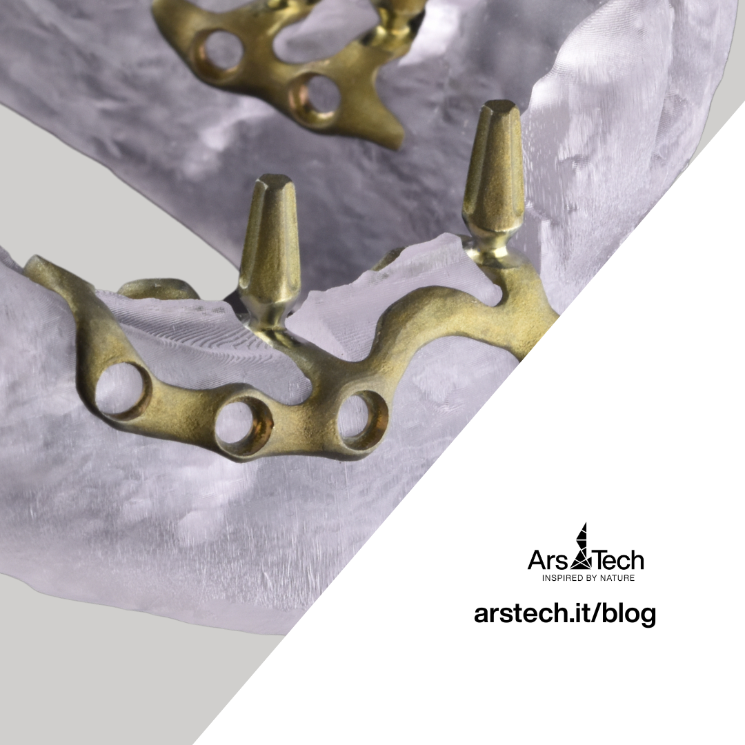 Impianto iuxta parziale "screw-retained".