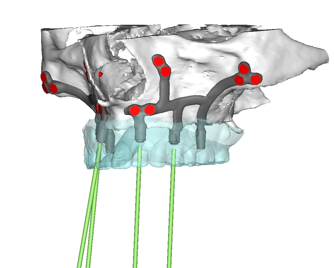 Design iuxta “screw retained”.