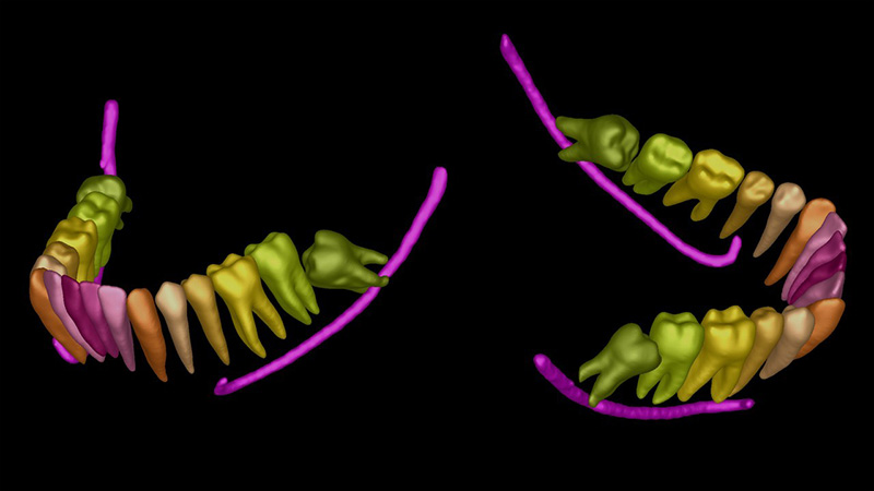 Segmentazione automatica di tutti gli elementi dentali in visione vestibolare e linguale