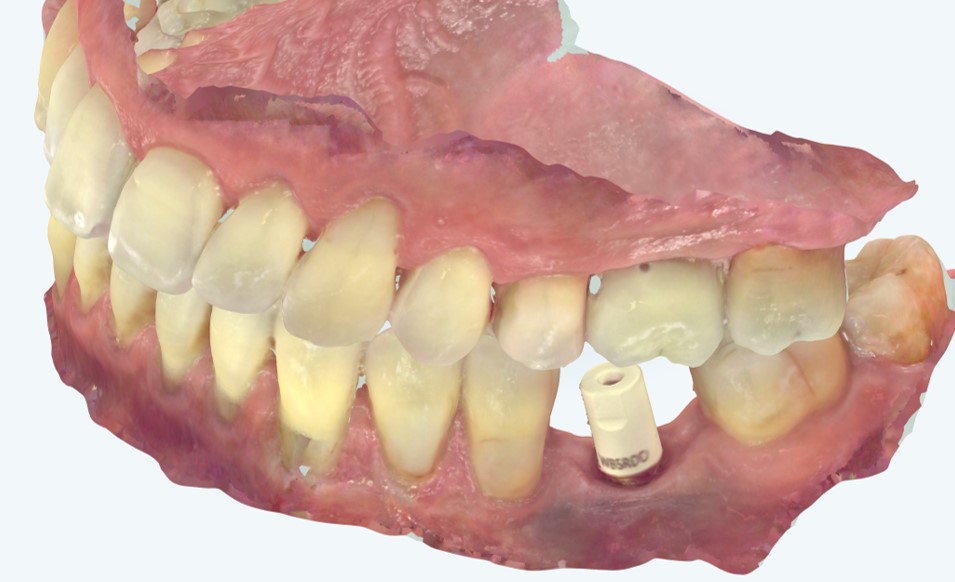 arcate in occlusione