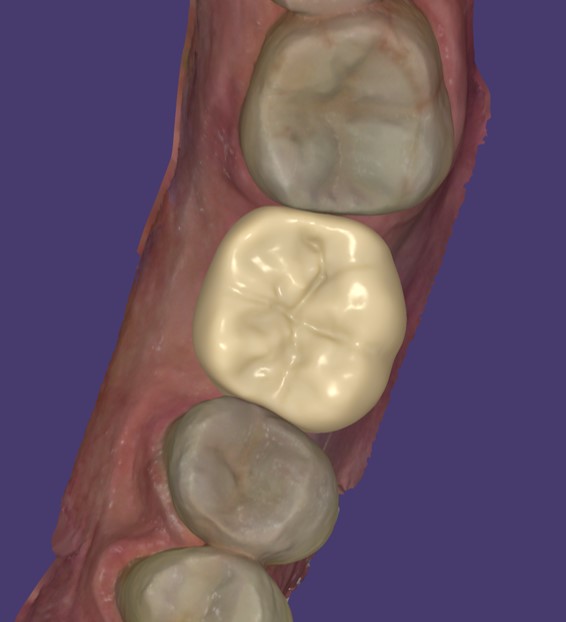dettaglio occlusione