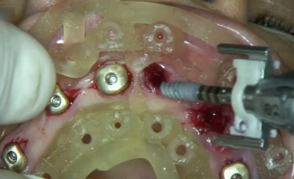 Posizionamento degli impianti attraverso la dima chirurgica