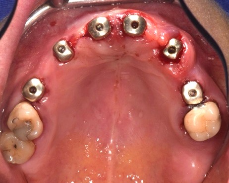 Fotografia degli impianti appena inseriti con iPhysio® avvitati